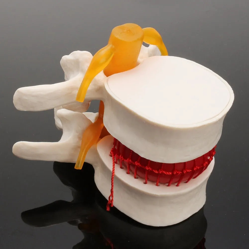 White PVC lumbar intervertebral disc herniation demonstration model for medical anatomy education