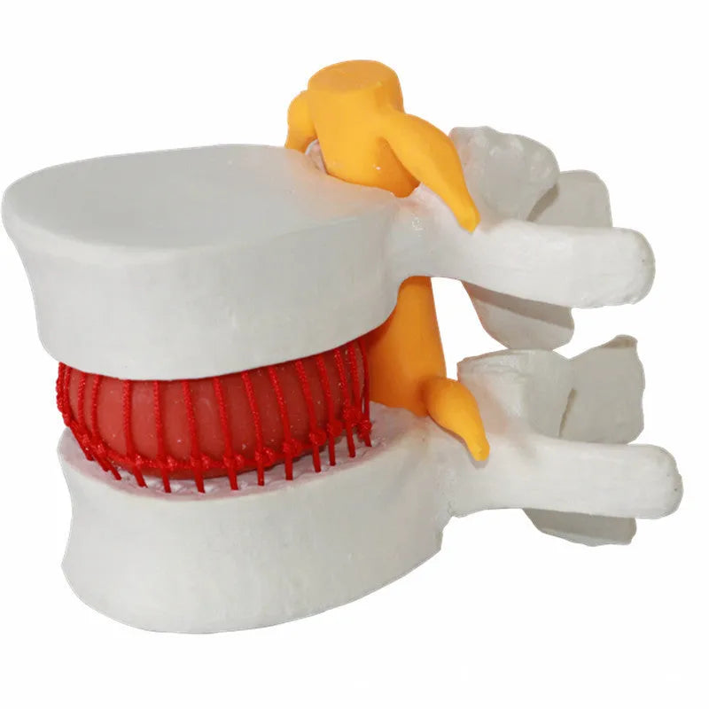 White PVC lumbar intervertebral disc herniation demonstration model for medical anatomy education