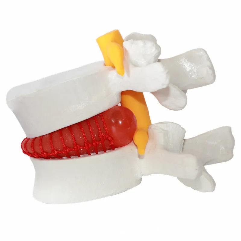 White PVC lumbar intervertebral disc herniation demonstration model for medical anatomy education