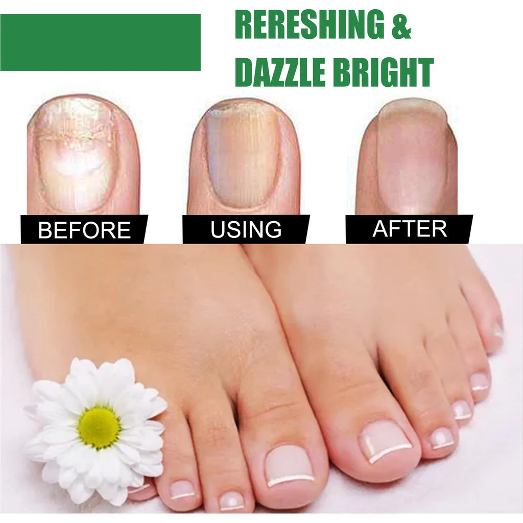 30ml bottle of tea tree oil nail repair liquid for fingernails and toenails