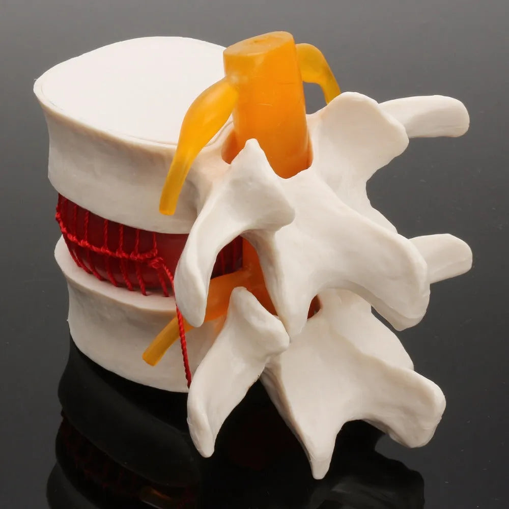 White PVC lumbar intervertebral disc herniation demonstration model for medical anatomy education