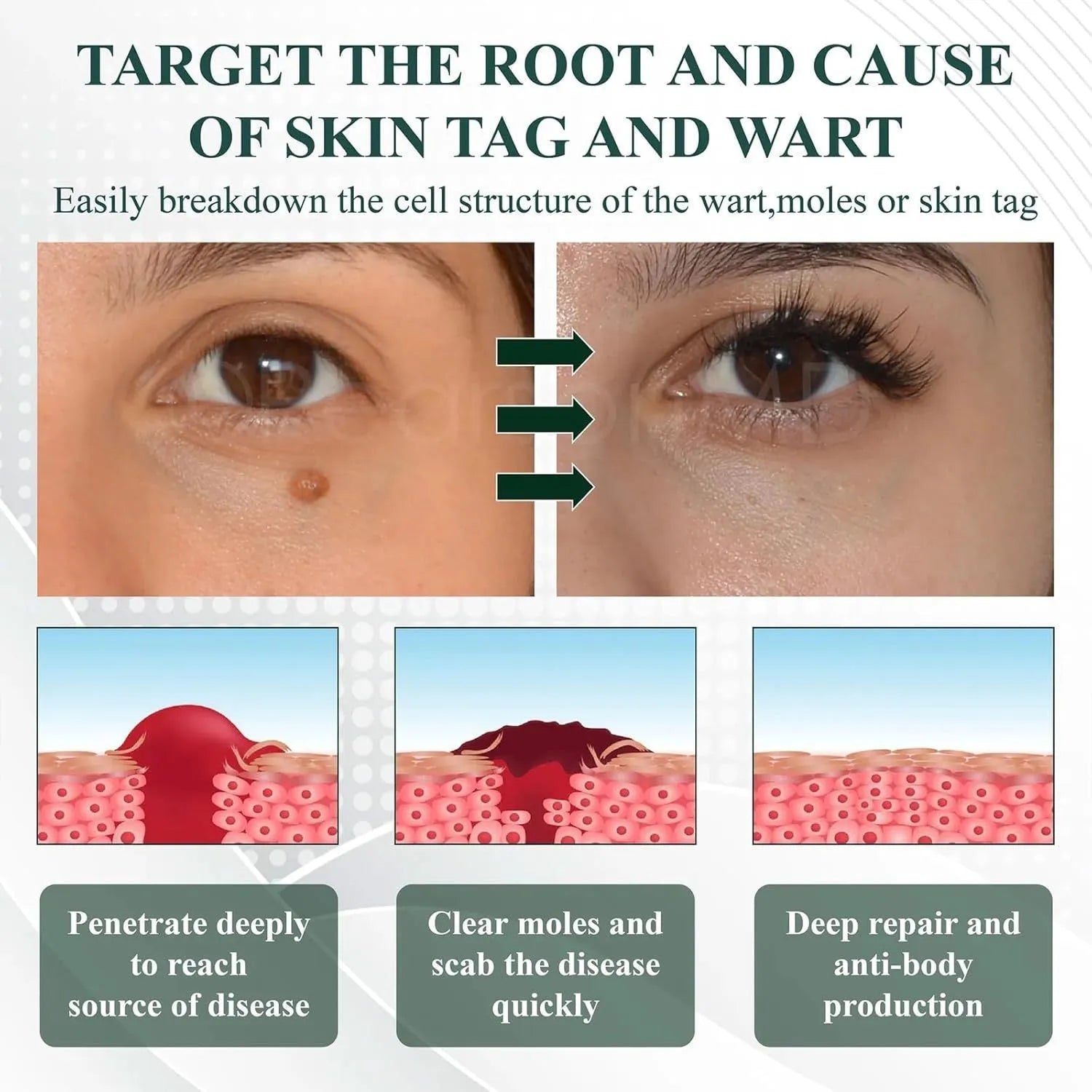Natureerase Instant Mole Spot Removal Gel 45g container with hydrating formula