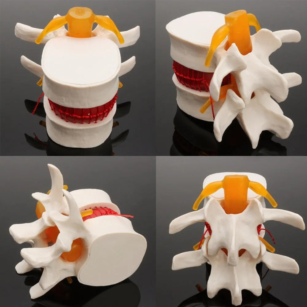 White PVC lumbar intervertebral disc herniation demonstration model for medical anatomy education