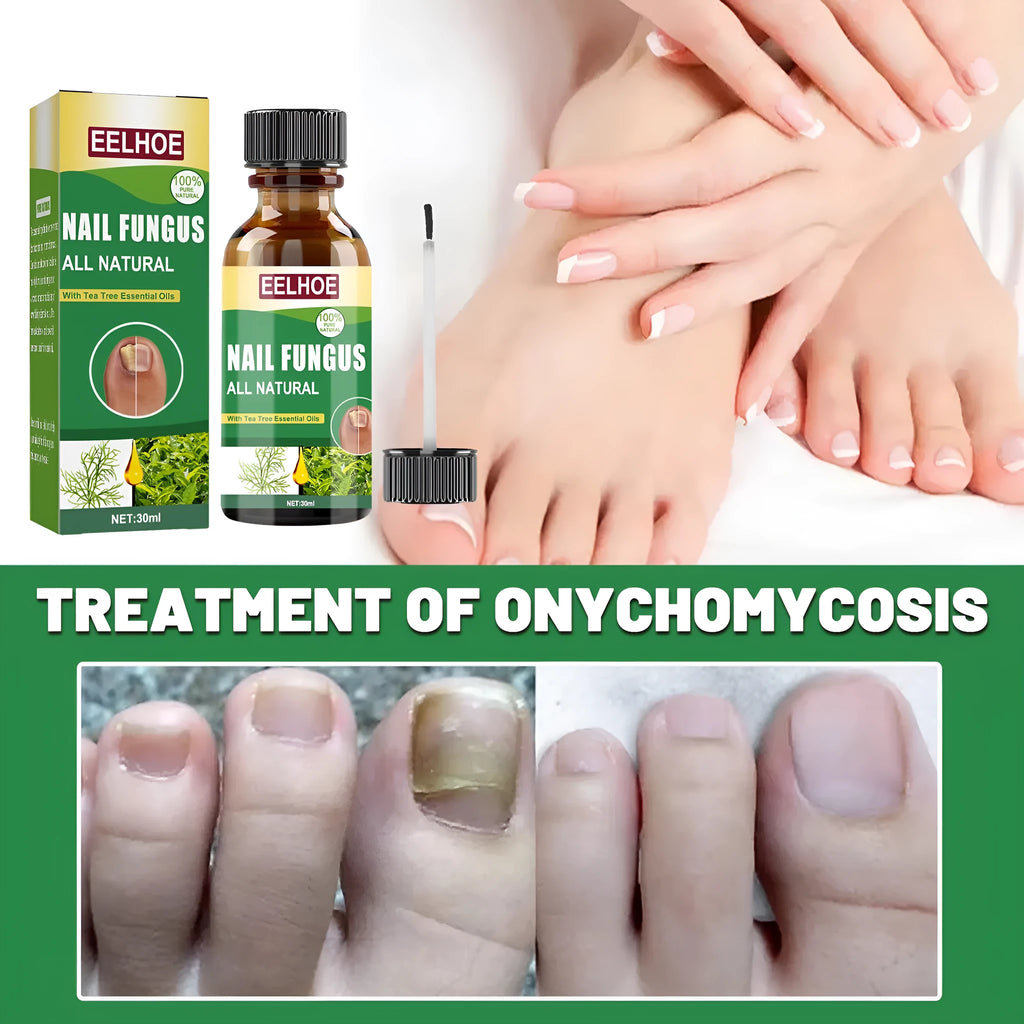 30ml bottle of tea tree oil nail repair liquid for fingernails and toenails