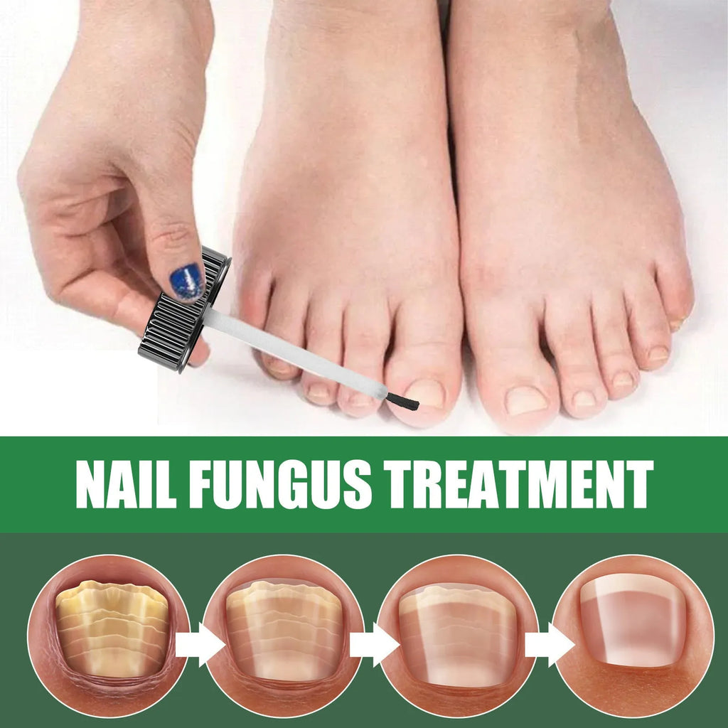 30ml bottle of tea tree oil nail repair liquid for fingernails and toenails